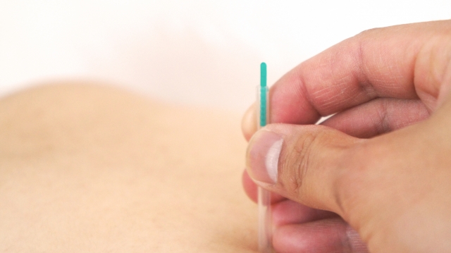 体の鍼灸施術写真