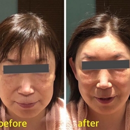 ビフォーアフター写真