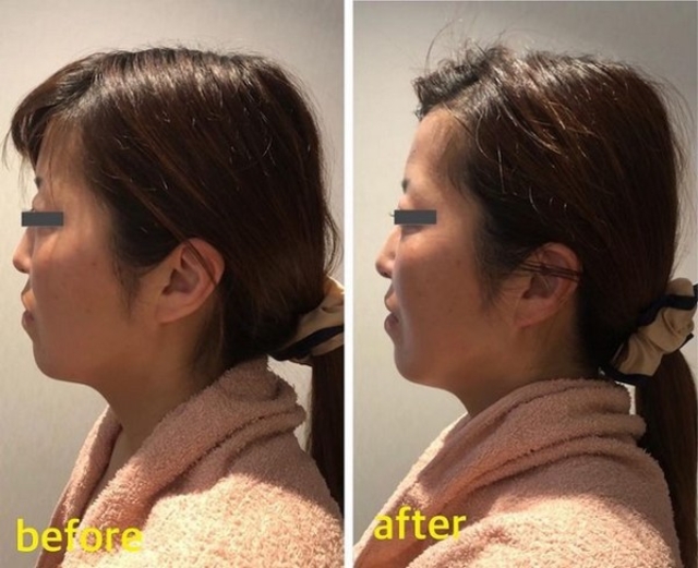 ビフォーアフター写真