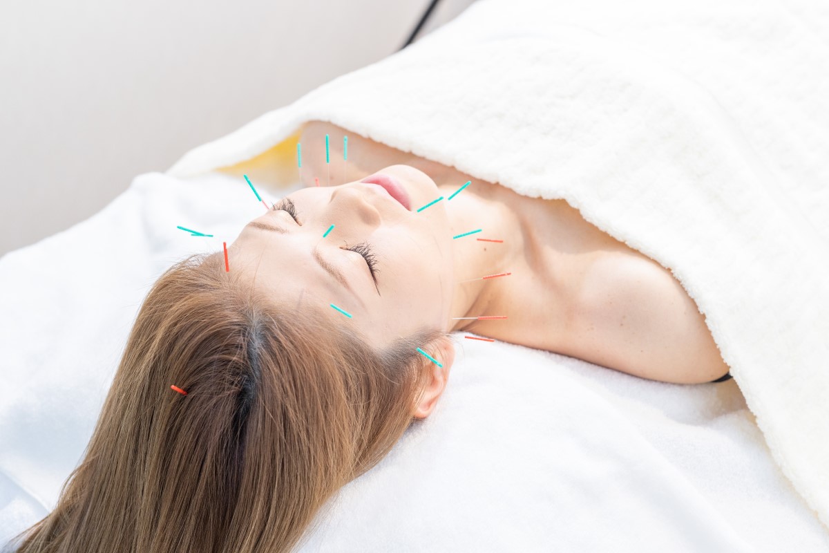 美容鍼灸の施術写真