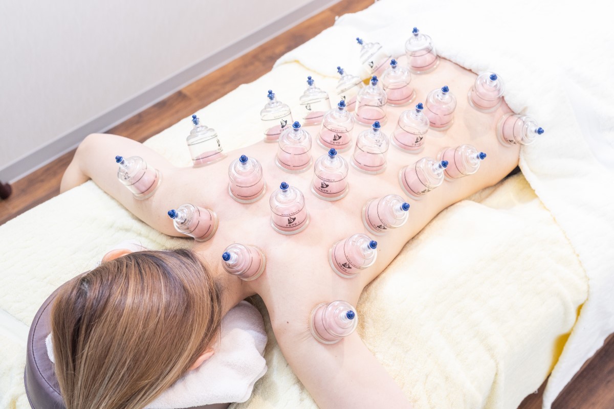 オイルカッピングの施術写真