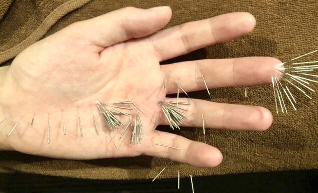 高麗手指鍼灸の施術写真