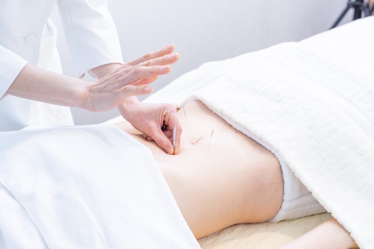 鍼灸治療の施術写真